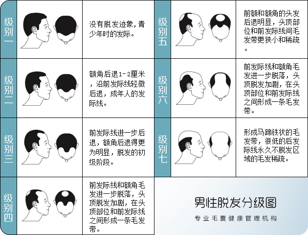 出现这几种情况你可要注意了 1分钟脱发自测